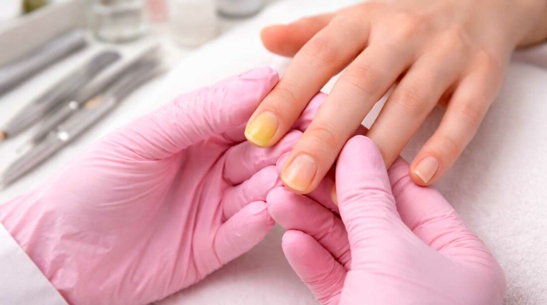 Unhas amareladas e micose de unha: cuidados essenciais para manicures