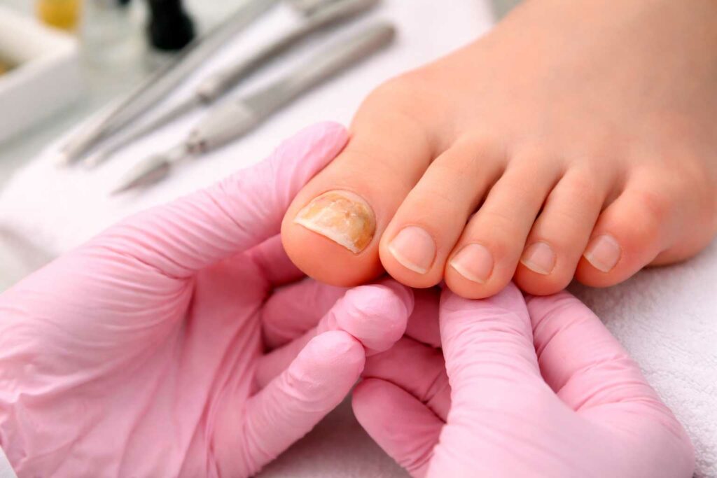 Unhas amareladas nem sempre são apenas um problema estético