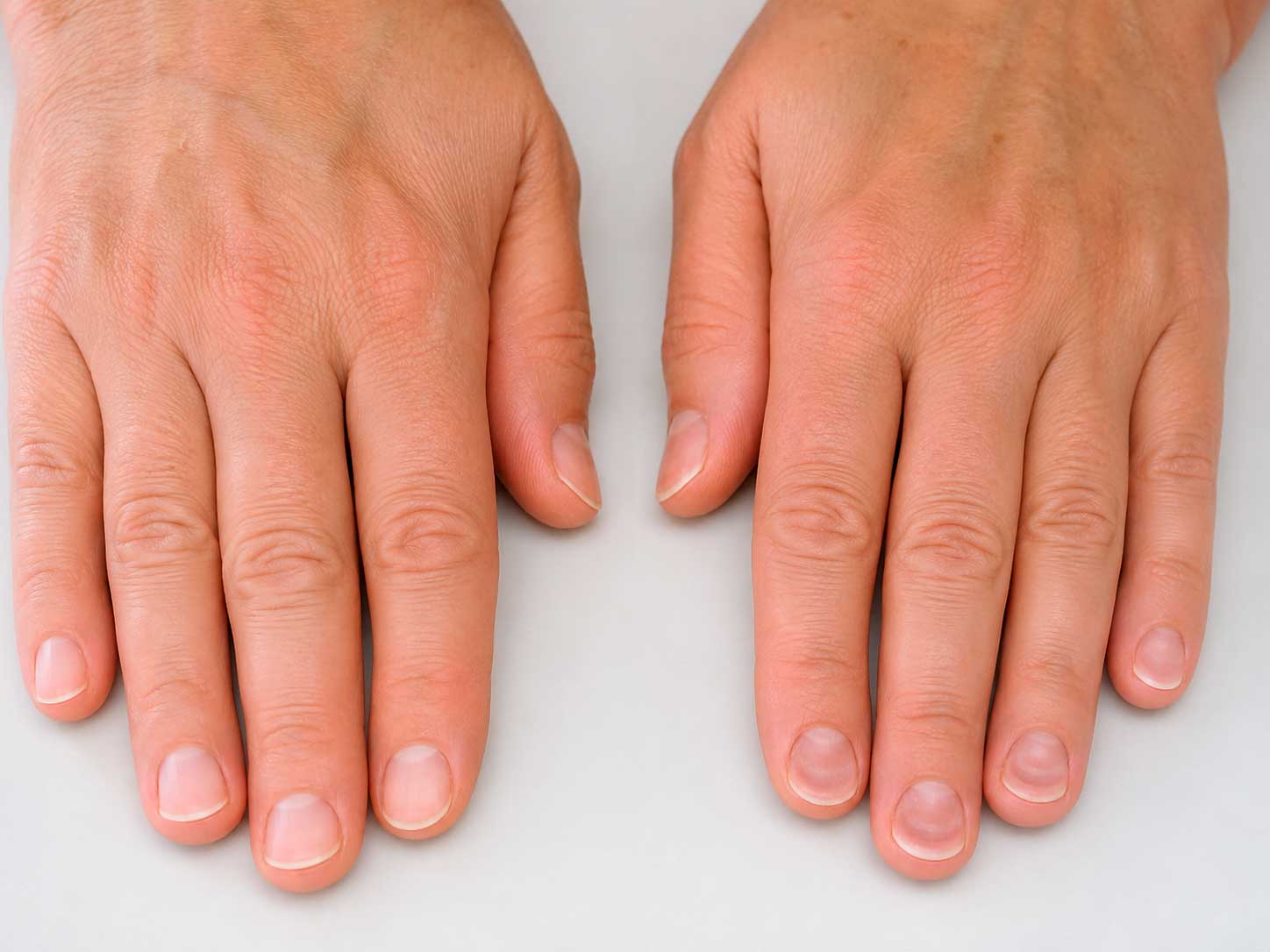 Comparação entre unhas saudáveis e unhas com coiloníquia