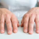 unhas-naturais-com-formato-concavo-caracteristico-da-coiloniquia