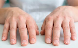 unhas-naturais-com-formato-concavo-caracteristico-da-coiloniquia