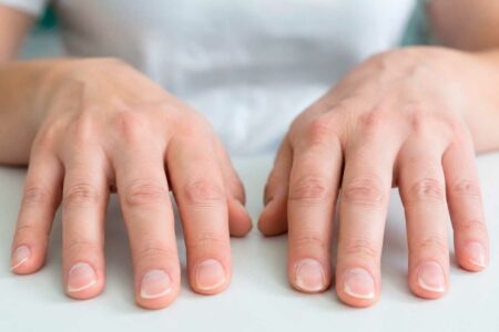 unhas-naturais-com-formato-concavo-caracteristico-da-coiloniquia