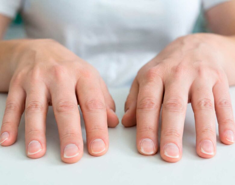 unhas-naturais-com-formato-concavo-caracteristico-da-coiloniquia